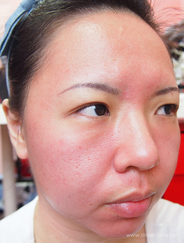 Skin Allergy2