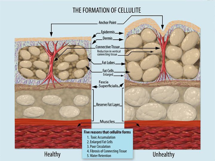 Formation-of-Cellulite