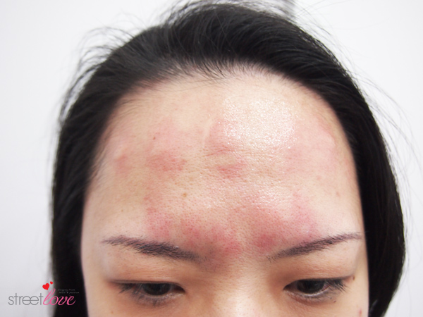 Renee Clinic Botox 6