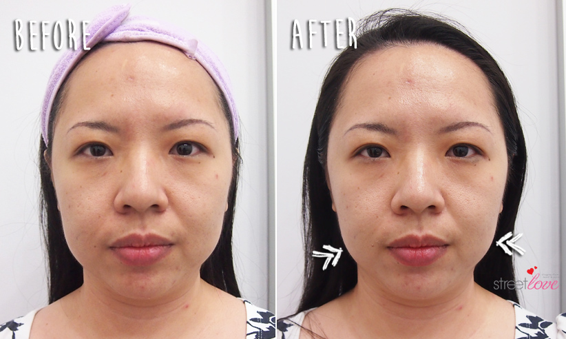 Renee Clinic Sublime Skin Contouring 17