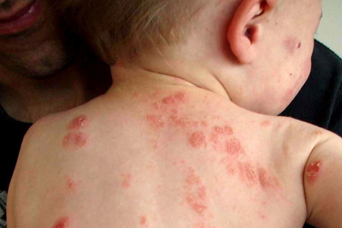 Eczema on Kids